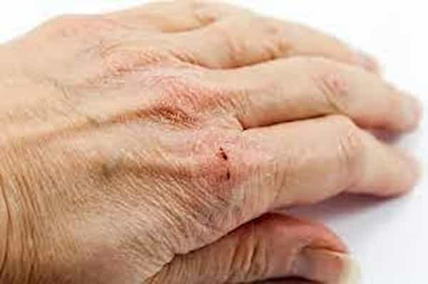 تصویر 2 از قیمت پماد ترک دست با کیفیت ارزان + خرید عمده